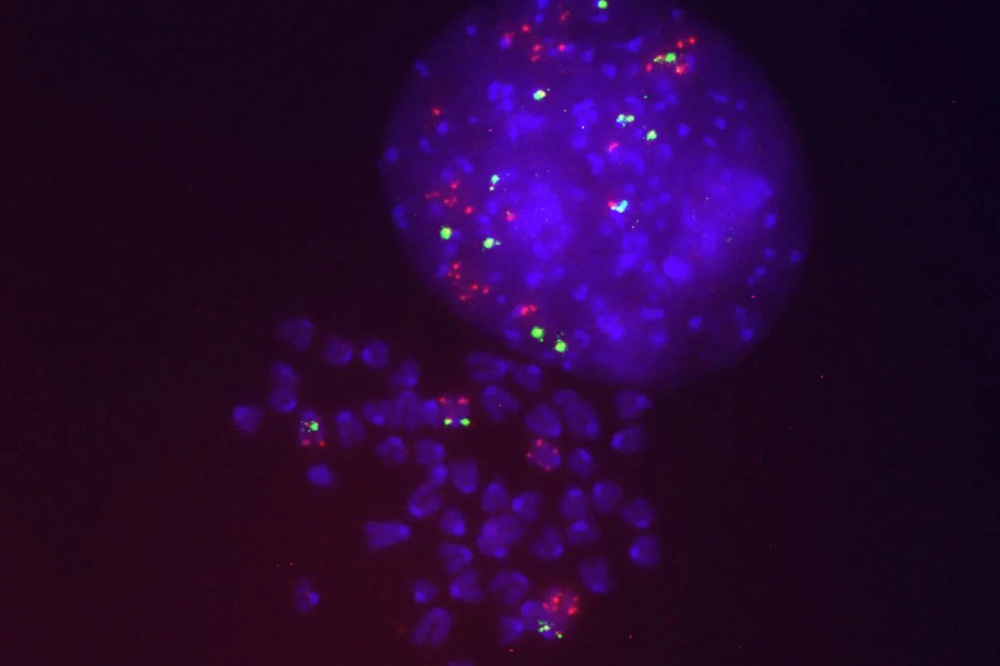 Células de cáncer de pulmón resistentes al sotorasib que presentan varias copias del gen KRAS mutado (en rojo). Foto: CICANCER. 