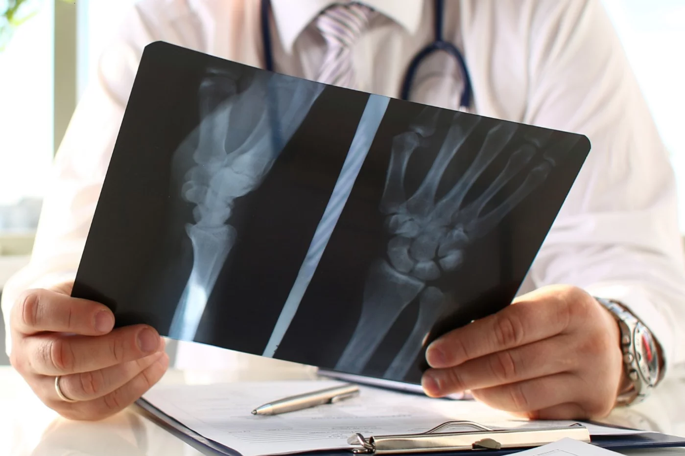 Niveles bajos de densidad ósea suelen conllevar mayor riesgo de fracturas. Foto: DM. 