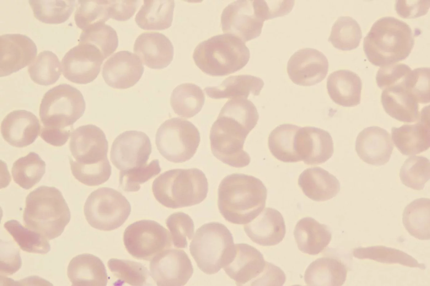 La anemia falciforme es una enfermedad rara en España, pero es uno de los trastornos hereditarios de la sangre más frecuentes en el mundo. Foto: SHUTTERSTOCK La anemia falciforme es una enfermedad rara en España, pero es uno de los trastornos hereditarios de la sangre más frecuentes en el mundo. Foto: SHUTTERSTOCK