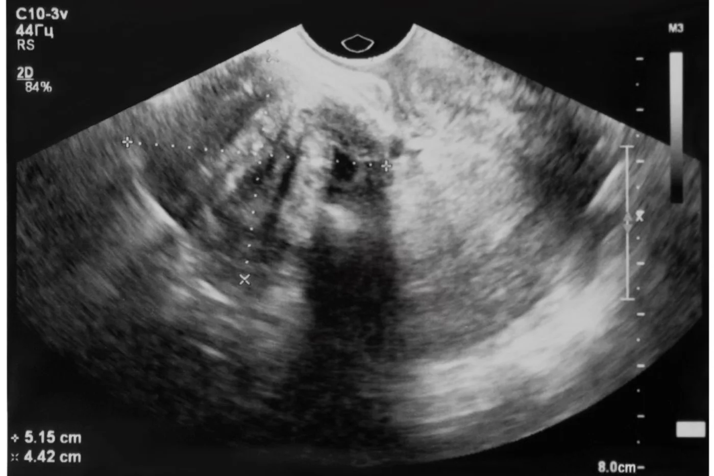 Imagen de ultrasonido de un mioma. Se estima que afectan al 30% de mujeres en edad fértil. Foto: SHUTTERSTOCK.