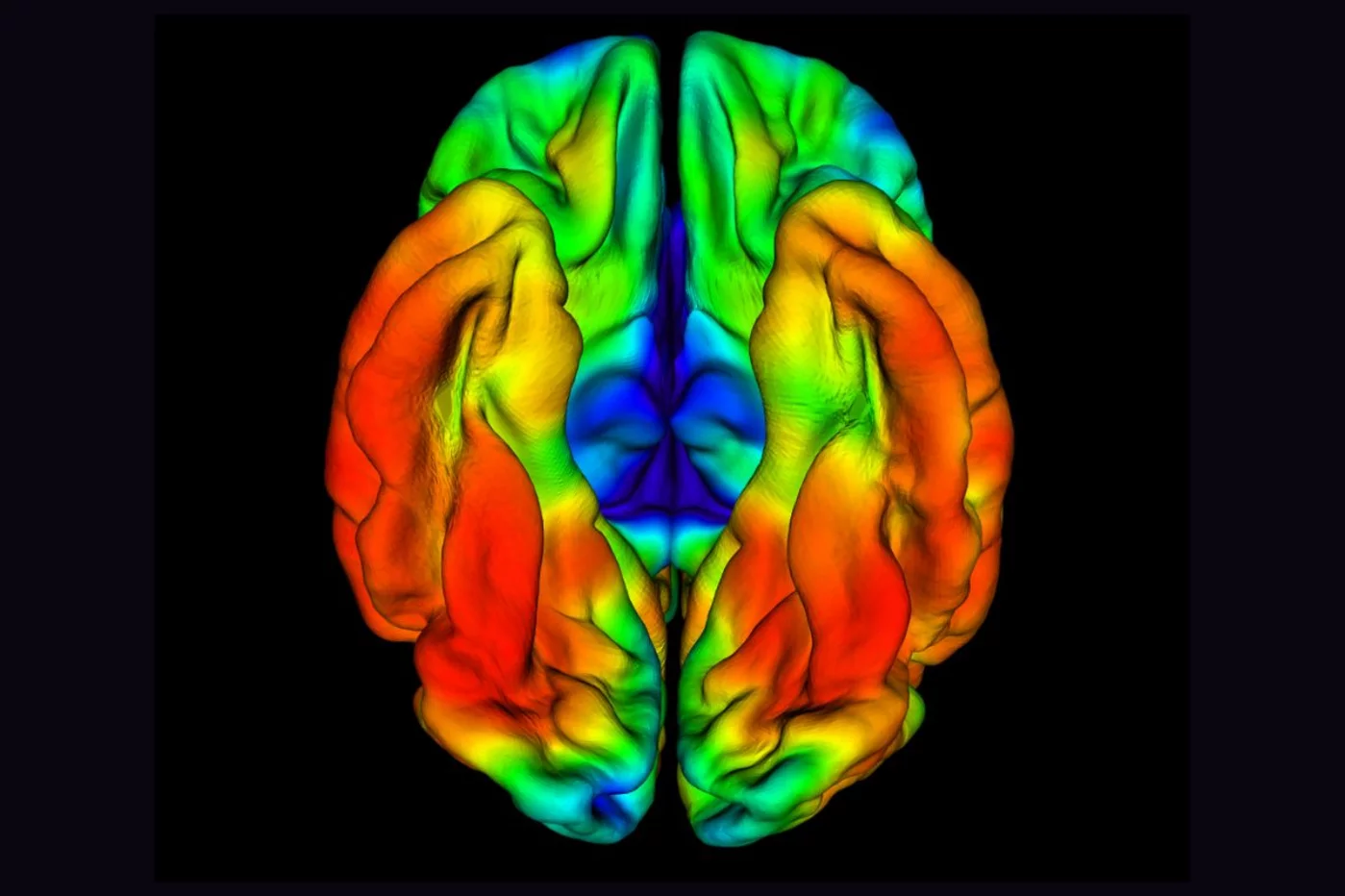 Imágenes de PET del portador RELN-COLBOS (H3447R) que muestran una agregación limitada de tau en la corteza entorrinal, una región del cerebro que se ve afectada característicamente en las primeras etapas clínicas de la enfermedad de Alzheimer. Foto: CEDIDA POR LA UNIVERSIDAD DE HARVARD.