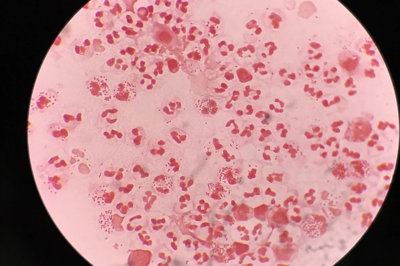 Una muestra de gonorrea vista al microscopio. Foto: SHUTTERSTOCK.