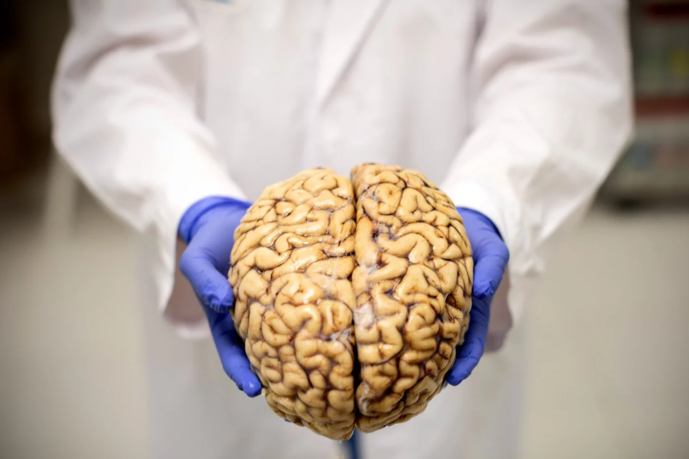 Banco de Cerebros de la fundación CIEN, donde llevan a cabo estudios sobre el Alzheimer. En la imagen, uno de los cerebros humanos que se conserva en el banco. Foto: ALBERTO DI LOLLI.