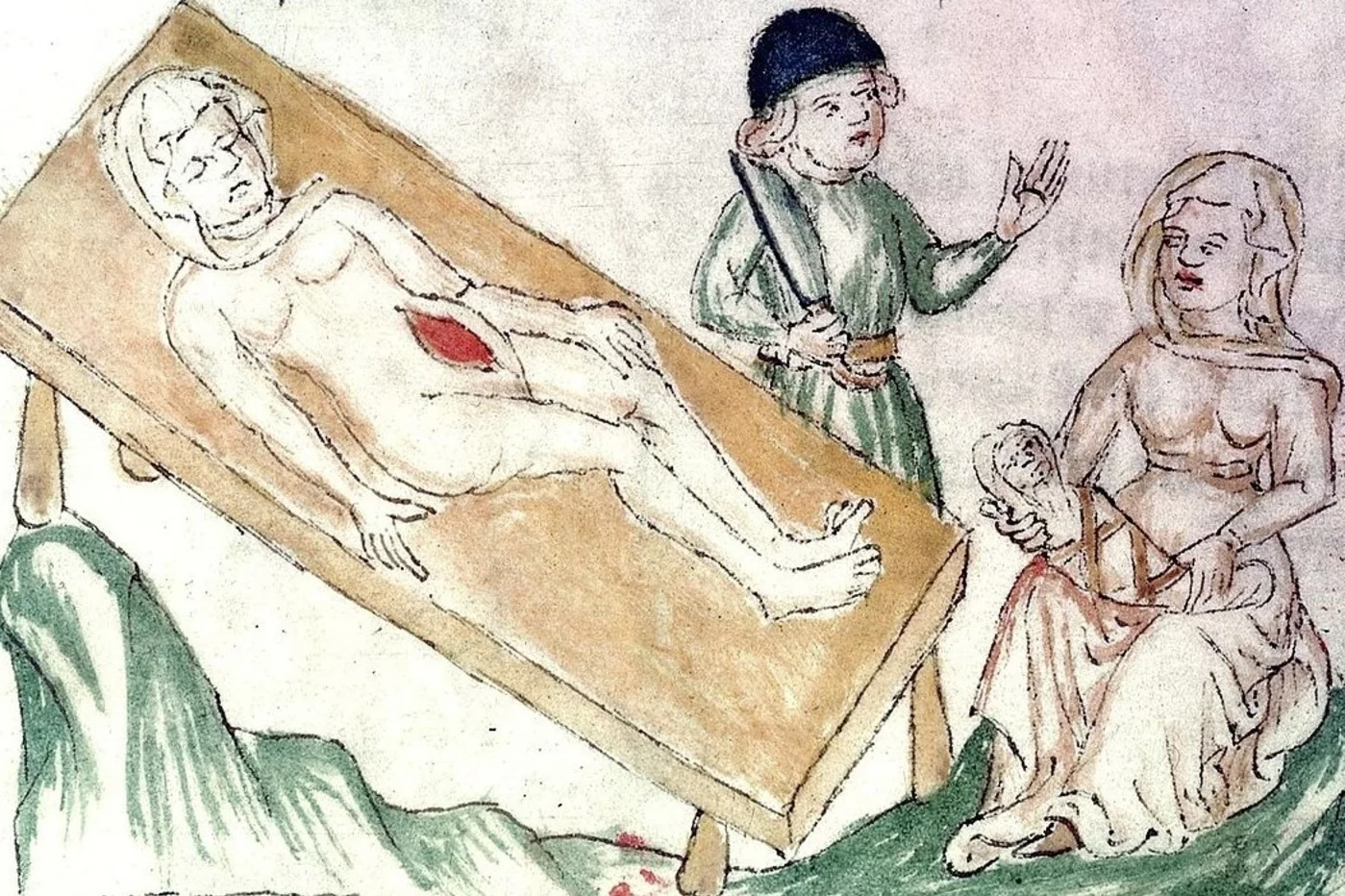 Representación medieval de una operación cesárea. [Imagen tomada de Old Book Illustrations]