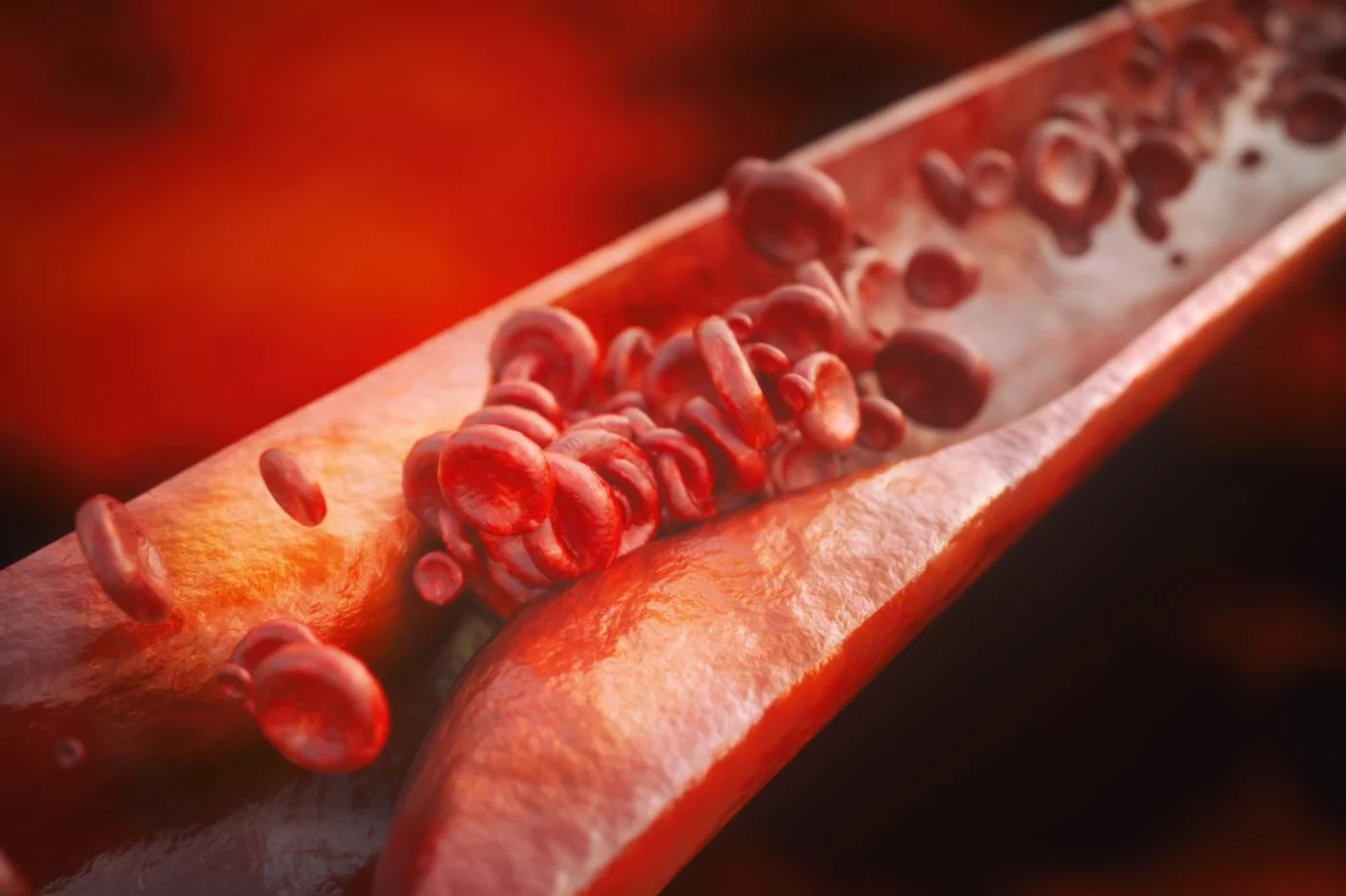 La aterosclerosis inicia el camino hacia enfermedades cardiovasculares. Foto: SUTTERSTOCK. 