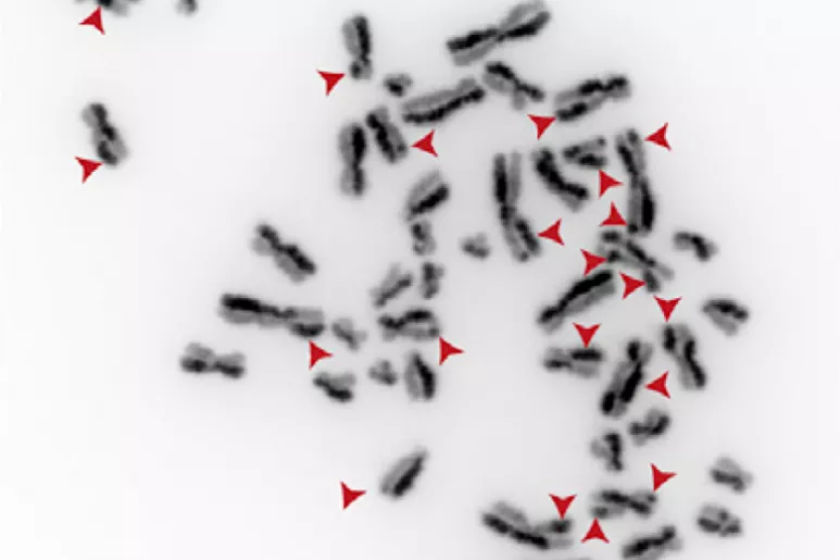 Cromosomas de células con mutaciones en el gen TOP3A que presentan numerosos intercambios SCE (Sister chromatid exchange).