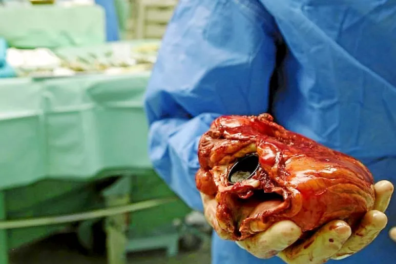 Un cirujano sujeta el corazón de un receptor en un momento de un trasplante cardíaco.