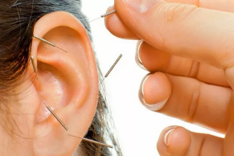 Tratamiento de acupuntura en la oreja