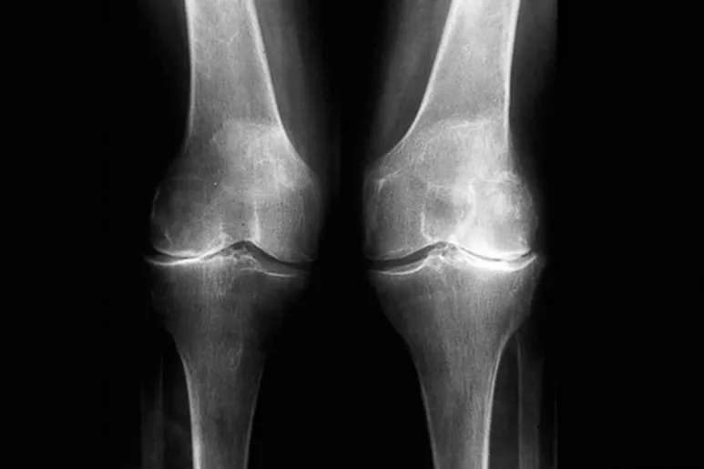 Dos rodillas con artrosis 