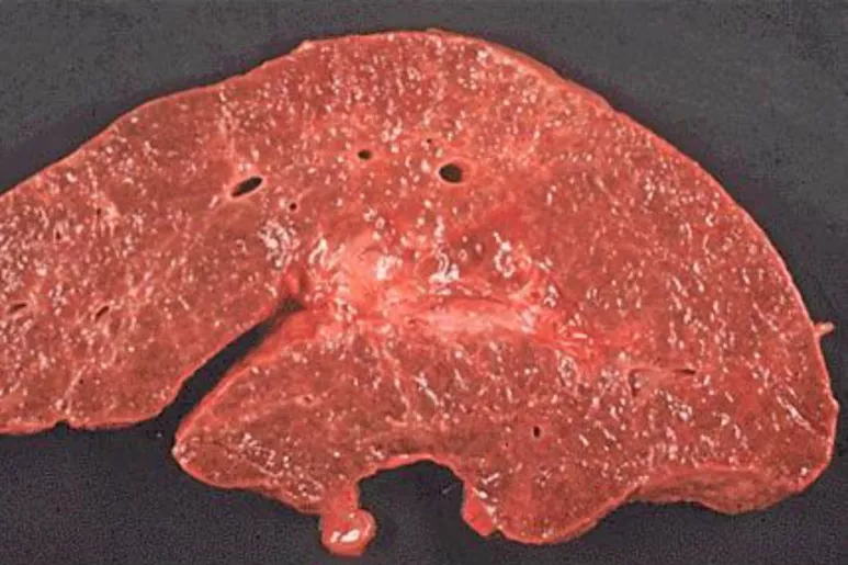 Hígado cirrótico por fibrosis quística.