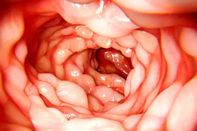 La enfermedad de Crohn es una dolencia crónica del aparato digestivo.