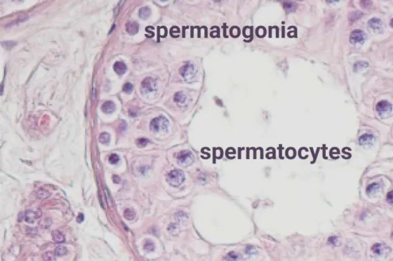 Imagen de la no producción de espermatozoides por bloqueo de meiosis en la azoospermia no obstructiva.