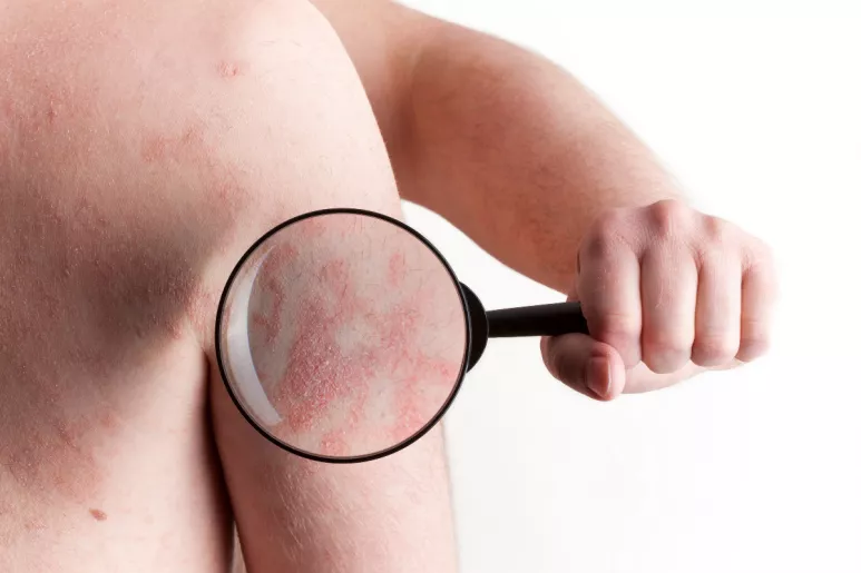 En su forma grave, la dermatitis atópica provoca eczemas en la piel, picor intenso y un gran impacto en quienes la sufren.