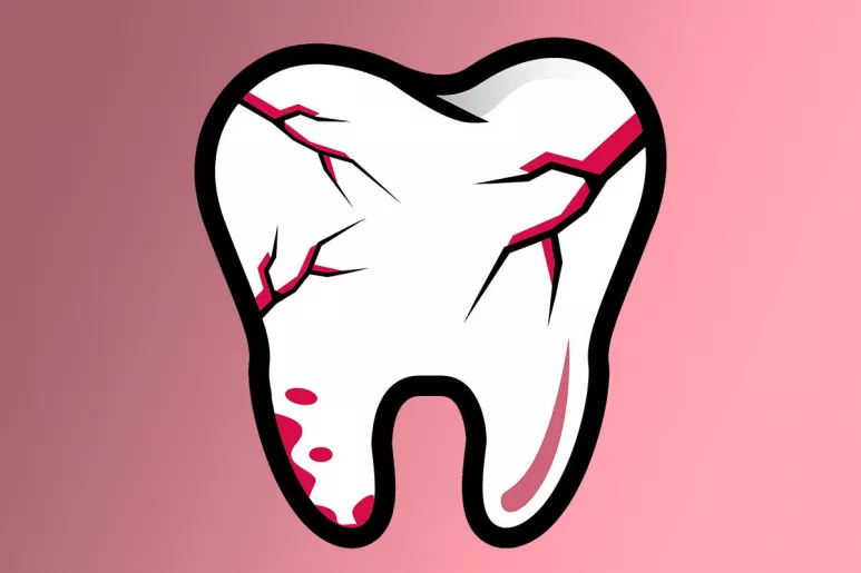 El dolor dental por caries se muestra como el más habitual o reconocible, aunque el producido por fractura, sobre todo vertical, también suele ser frecuente.