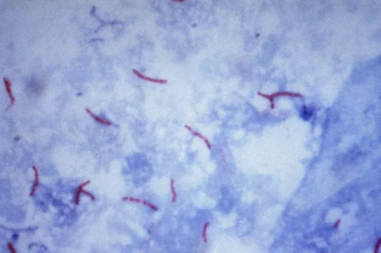 Visualización de 'Mycobacterium tuberculosis' mediante una baciloscopia, usando la tinción de Ziehl-Neelsen.