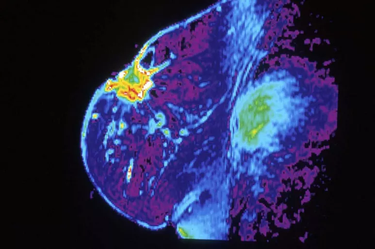 Cáncer de mama en imagen de mamografía.