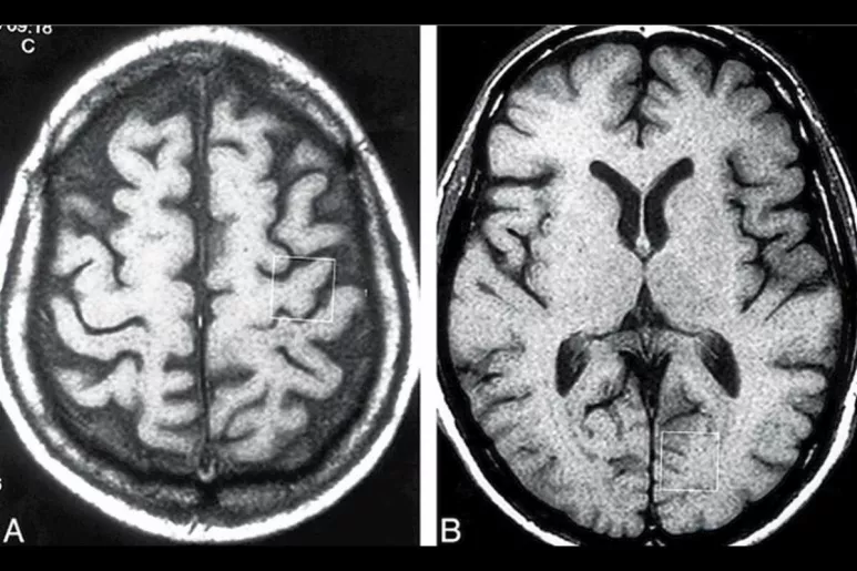 La ELA se caracteriza por una degeneración progresiva de las neuronas motoras en el tronco del encéfalo, en la corteza cerebral y en la médula espinal.