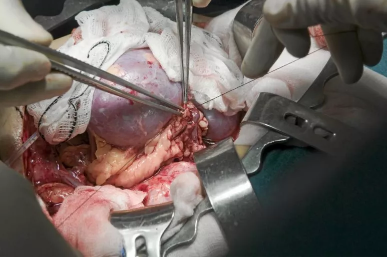 Momento del implante de un trasplante de riñón.