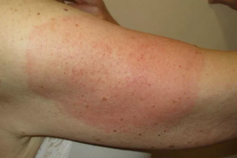 El brazo es el lugar donde más frecuentemente se registran reacciones de la vacuna covid-19. Foto: Hospital de Granollerss