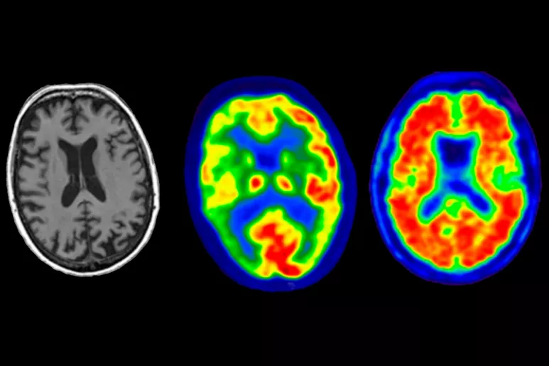 Imagen en la atrofia cortical posterior por enfermedad de Alzheimer, por resonancia magnética, PET con 18F-fluorodesoxiglucosa y PET con 18F-florbetapir.