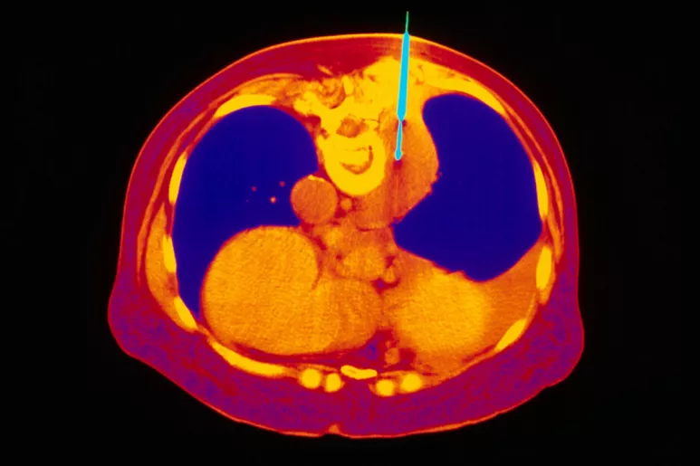 Biopsia de un cáncer de pulmón, ejemplo paradigmático de la aportación de la medicina personalizada.