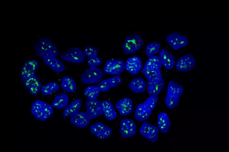 Células metastásicas de cáncer de mama. 