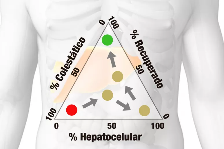 Diagramas gráficos ternarios, en el que cada uno de los vértices del triángulo representa el grado de daño hepatocelular, colestásico o grado de recuperación de un paciente en un momento determinado. Ilustración: L. Esparza.