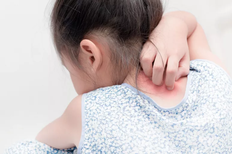 Cerca de un 20% de los niños son diagnosticados de dermatitis atópica.