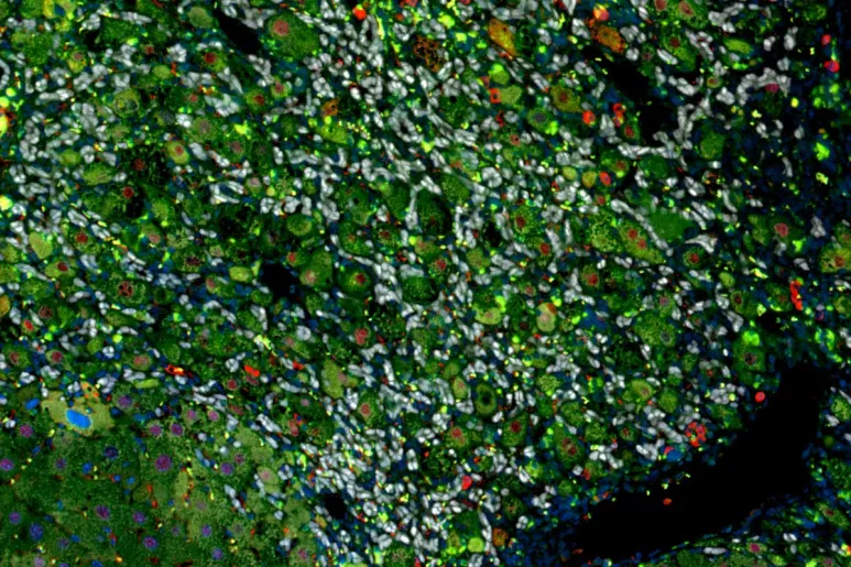 Imagen de un hígado de ratón con cirrosis en la que distintos tipos de células del hígado han sido marcadas con fluoróforos que se distinguen en los colores blanco, verde y rojo.FOTO: Nabil Djouder. CNIO.