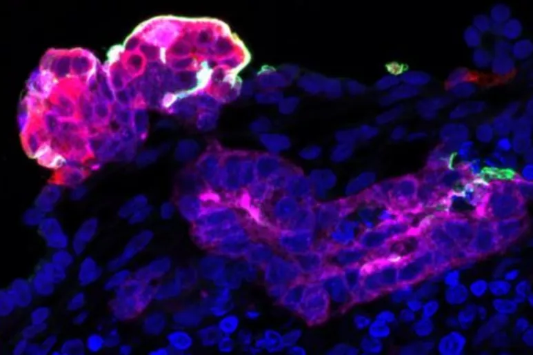 Estructura tubular proximal (magenta) de un organoide renal tras infección por SARS-CoV-2, que muestra células positivas para ACE2 (verde) y células infectadas con SARS-CoV-2 (rojo). Foto: IBC