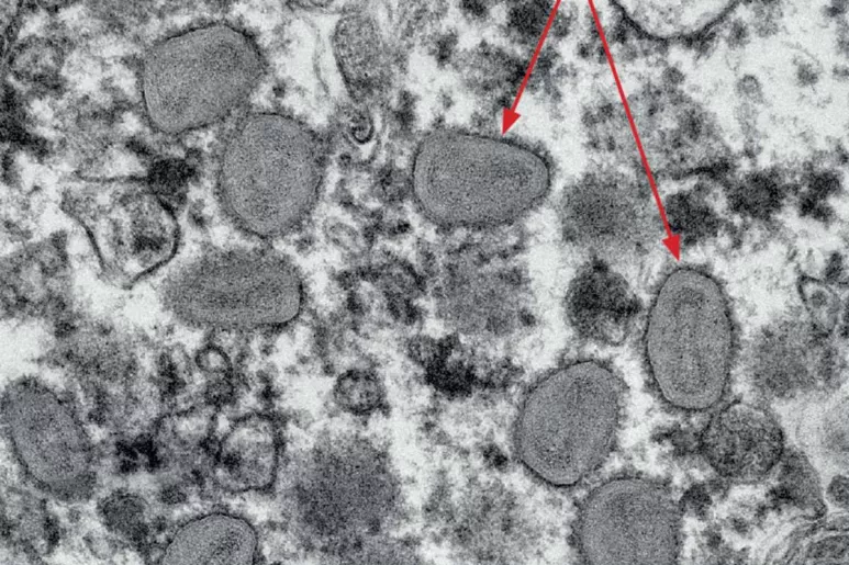 Micrografía electrónica de partículas víricas similares a la viruela de un caso de viruela del mono importado a Australia desde Europa.