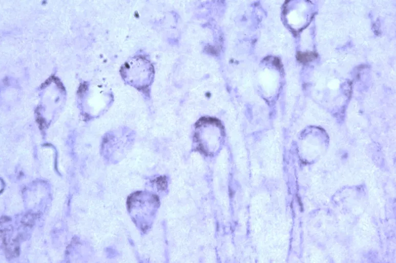 Patología de la proteína tau similar a la observada en los cerebros con Alzheimer. Foto: USF