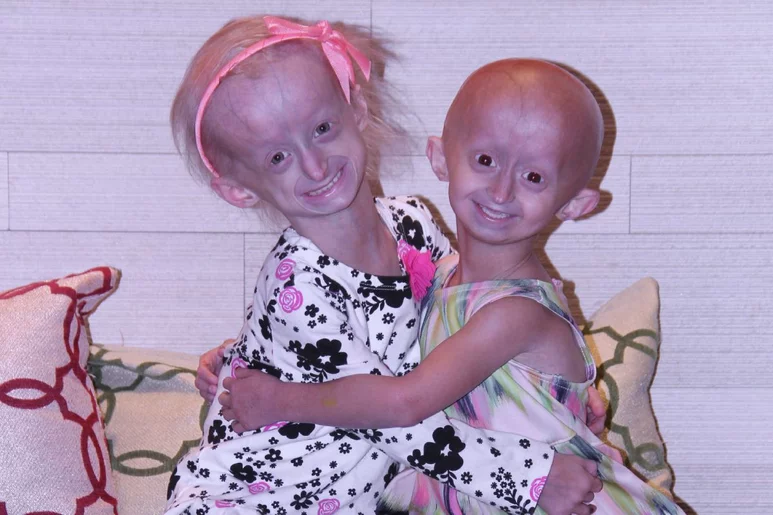 La progeria se caracteriza por una serie de rasgos físicos, y trastornos propios de la edad avanzada, como diabetes, osteoporosis y cáncer. Foto: FUNDACIÓN PARA INVESTIGACIÓN EN PROGERIA.