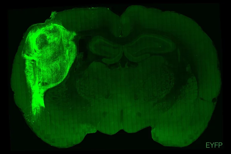 Organoide humano trasplantado en el cerebro de una rata, marcado con proteína fluorescente. Foto: UNIVERSIDAD DE STANFORD