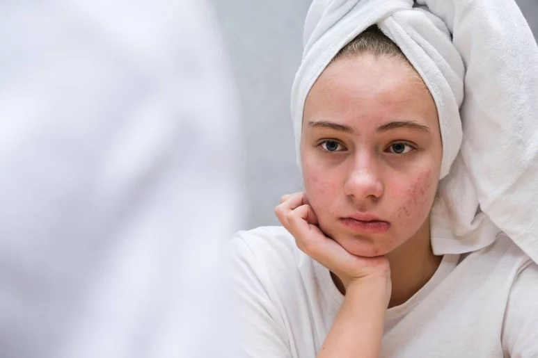 El acné es una afección de la piel que suele darse durante la pubertad. Foto: SHUTTERSTOCK