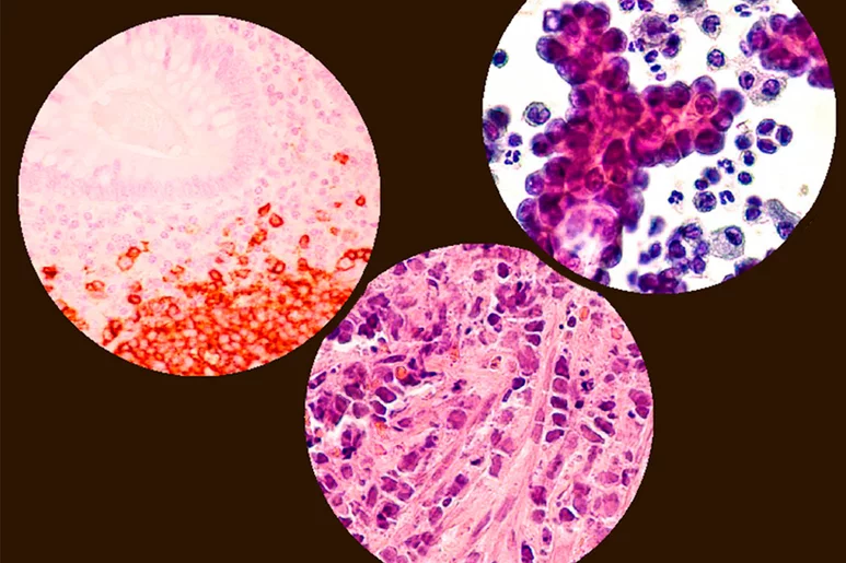 Imágenes de células de cáncer de pulmón. 