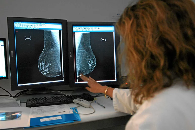 El carcinoma ductal in situ se detecta mediante mamografía.