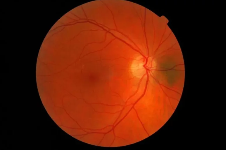 Las células de la retina pueden verse afectadas por distintas enfermedades. Foto: DM. 
