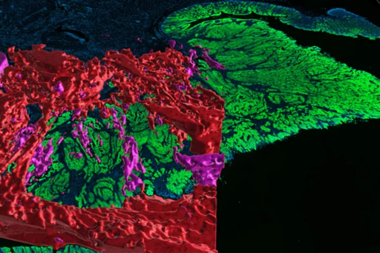 La imagen 3D muestra una red compleja y extensa de canales y cavernas (en rojo y rosa) con células cancerígenas que forman proyecciones en forma de dedos (no visibles). Imagen: CLARENCE YAPP Y SORGER. HARVARD. 