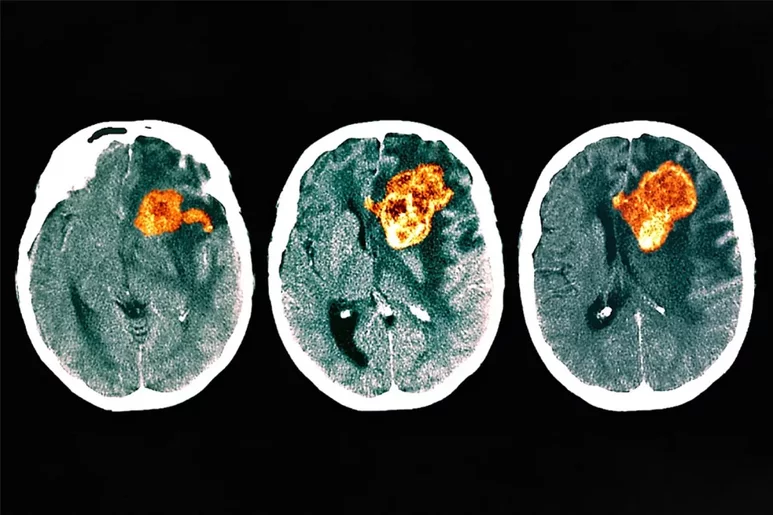 TAC a color de la cabeza de un paciente con glioblastoma. Imagen: ZEPHYR