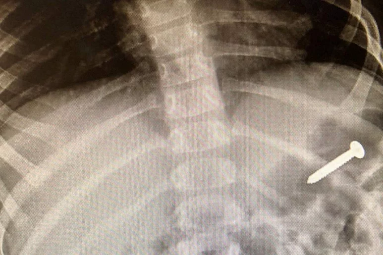 Radiografía que muestra un clavo alojado dentro de un niño. Foto: SHUTTERSTOCK.