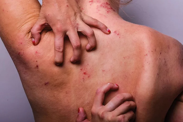 La dermatitis atópica es una patología que afecta significativamente a la calidad de vida. Foto: DM. 