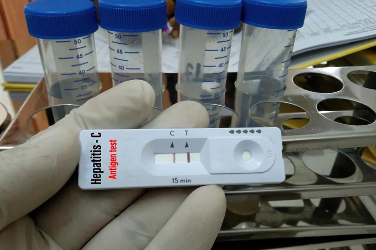 Resultado positivo en un test rápido de detección del virus de la hepatitis C. Foto: SHUTTERSTOCK