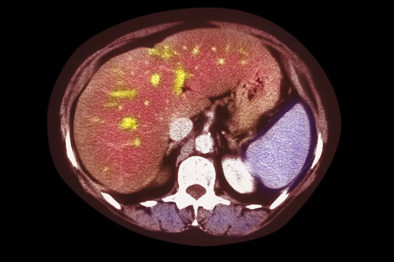 Tomografía computarizada de una mujer de 66 años con hígado graso. Los depósitos de grasa aparecen como manchas azules. Foto: AGEFOTOSTOCK 