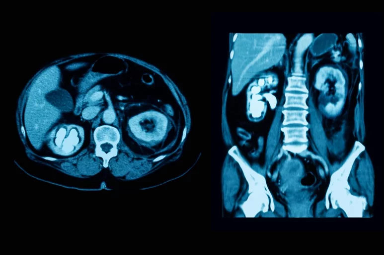 Tomografía computarizada del tracto urinario, que muestra un cálculo en el riñón derecho. Foto: SHUTTERSTOCK