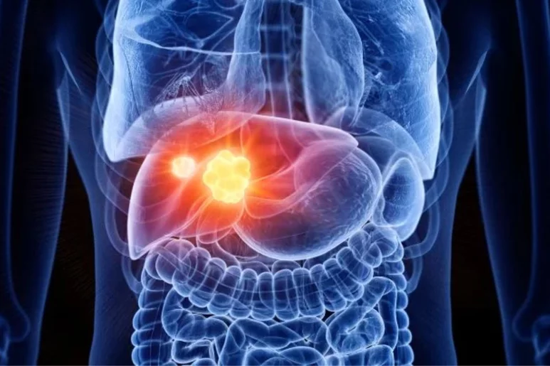 El de hígado es uno de los tumores más frecuentemente diagnosticados. Foto: DM. 