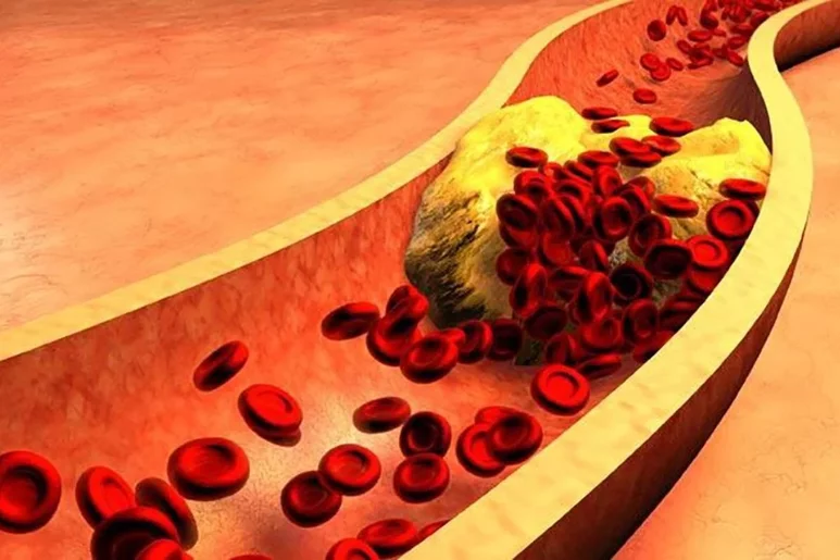 La acumulación de colesterol en sangre es responsable de múltiples enfermedades. Foto: DM. 