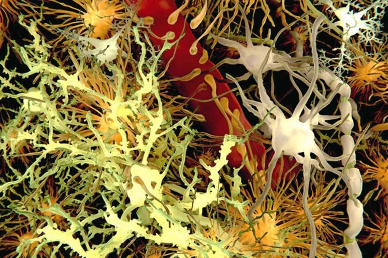Ilustración del beta-amiloide cerebral. Los nuevos fármacos 'limpian' los depósitos de esta proteína. 
