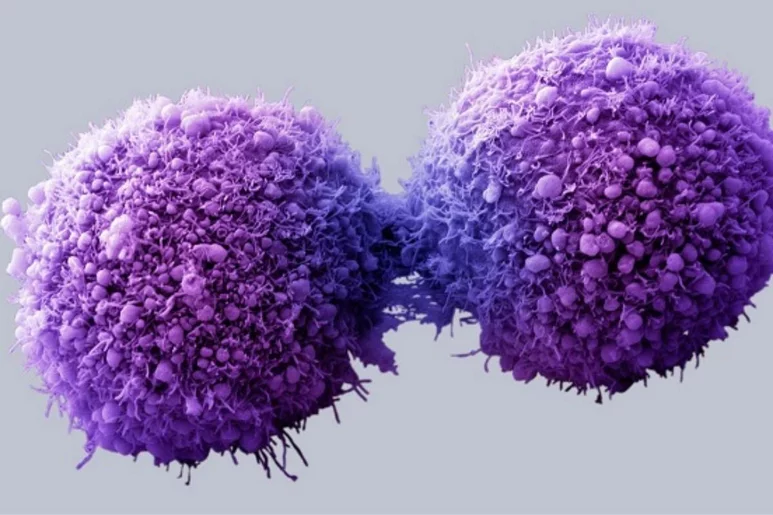 Los pacientes con cáncer de páncreas que tomaron lorazepam casi cuadruplicaron las posibilidades de progresión o muerte. En la imagen, células de cáncer de páncreas.