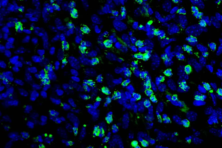 Células NK (en verde) actúan frente a células tumorales (en azul). Foto: NAVARRABIOMED